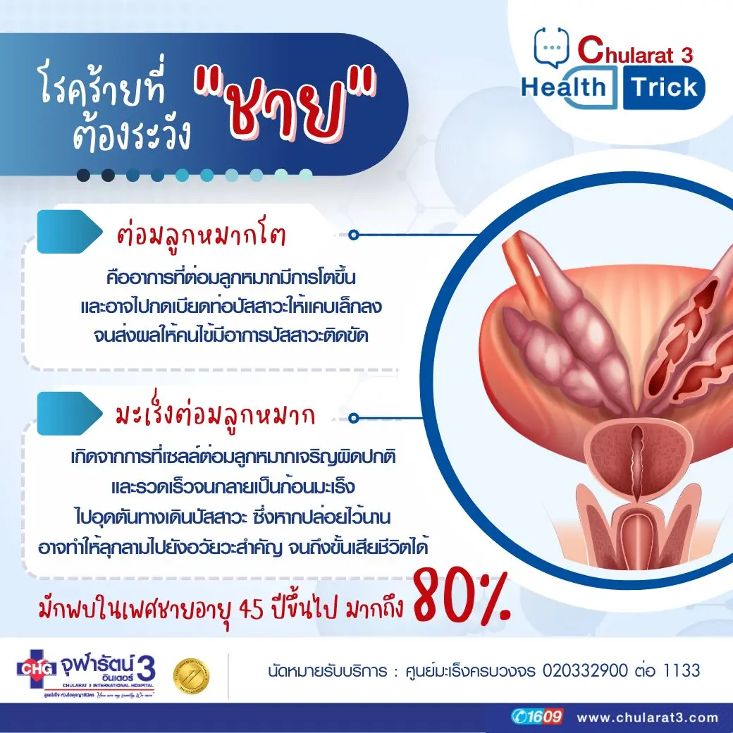 article-โรคร้ายที่ "ชาย" ต้องระวัง