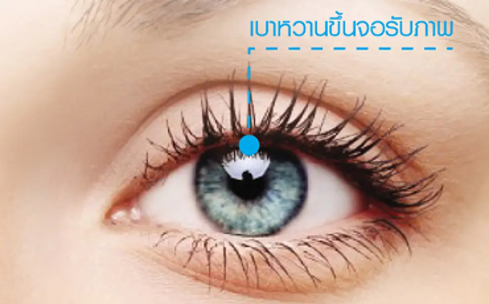 article-โรคเบาหวานขึ้นตา Diabetic Retinopathy