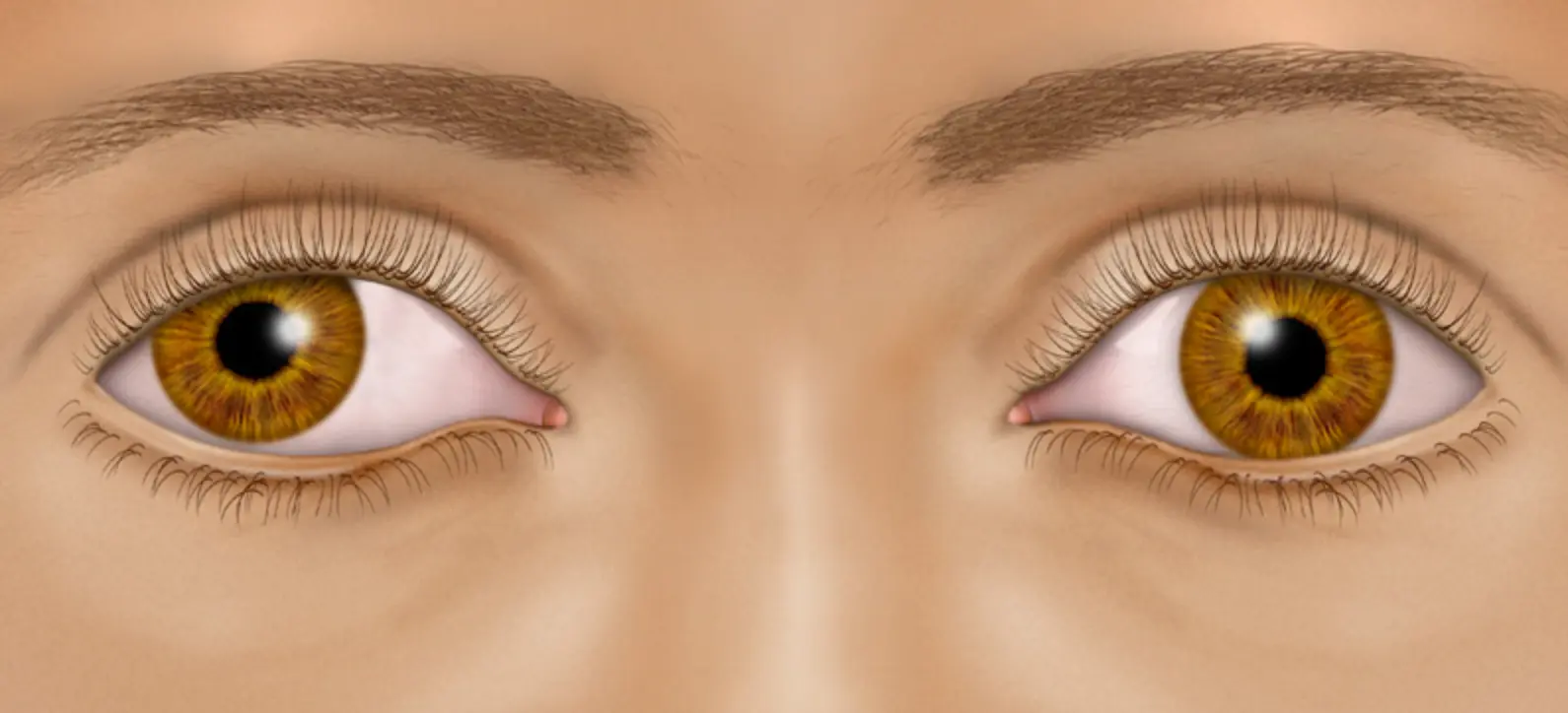 article-โรคสายตาขี้เกียจ หรือ Lazy Eyes
